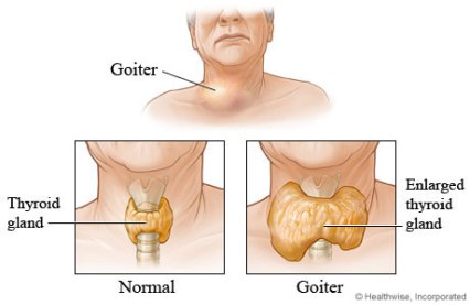 Thyroid Goiter